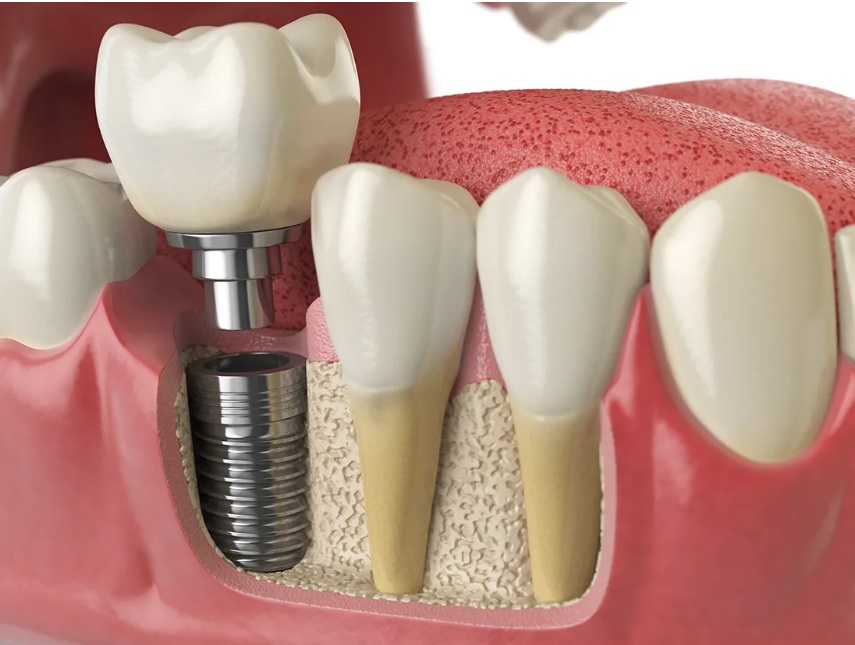 Răng Implant có nhiều tính vượt trội hơn so với cầu răng sứ và hàm tháo lắp