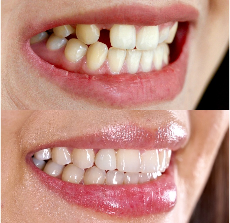 Trồng răng Implant là giải pháp tối ưu cho nụ cười 